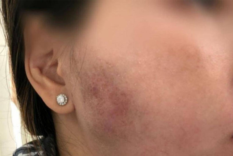 Dấu hiệu tiêm filler bị hoại tử chi tiết và cập nhật mới nhất 2025