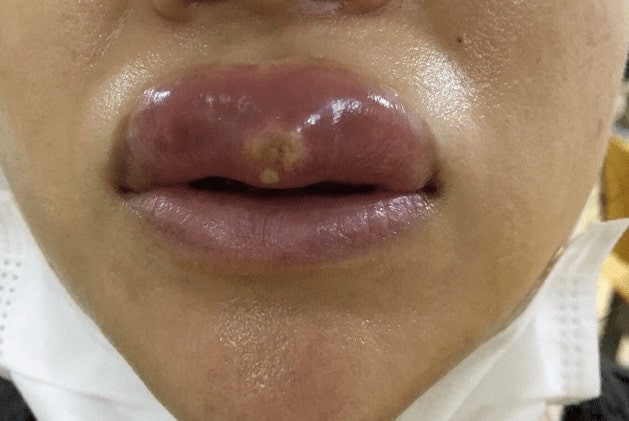 mụn bọc hoặc mủ trong khu vực tiêm filler